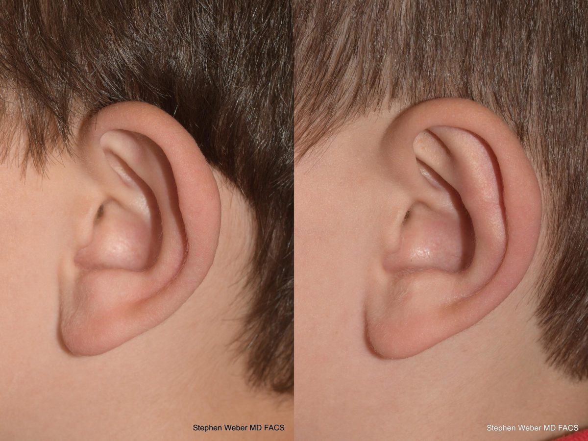Otoplasty Before and After | Weber Facial Plastic Surgery