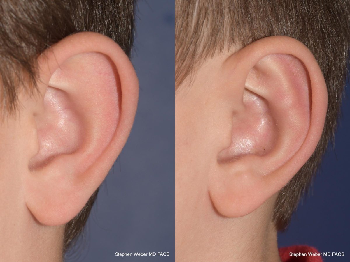 Otoplasty Before and After | Weber Facial Plastic Surgery
