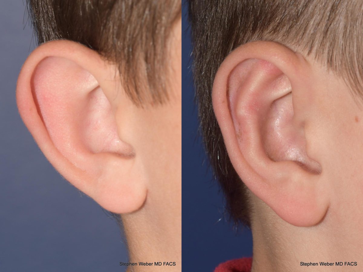 Otoplasty Before and After | Weber Facial Plastic Surgery