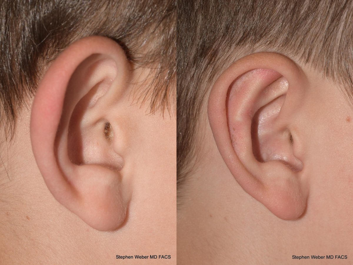 Otoplasty Before and After | Weber Facial Plastic Surgery