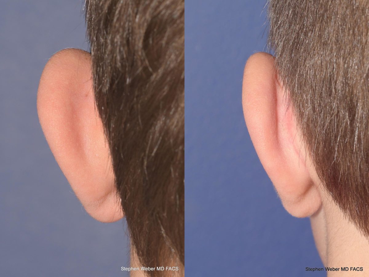 Otoplasty Before and After | Weber Facial Plastic Surgery