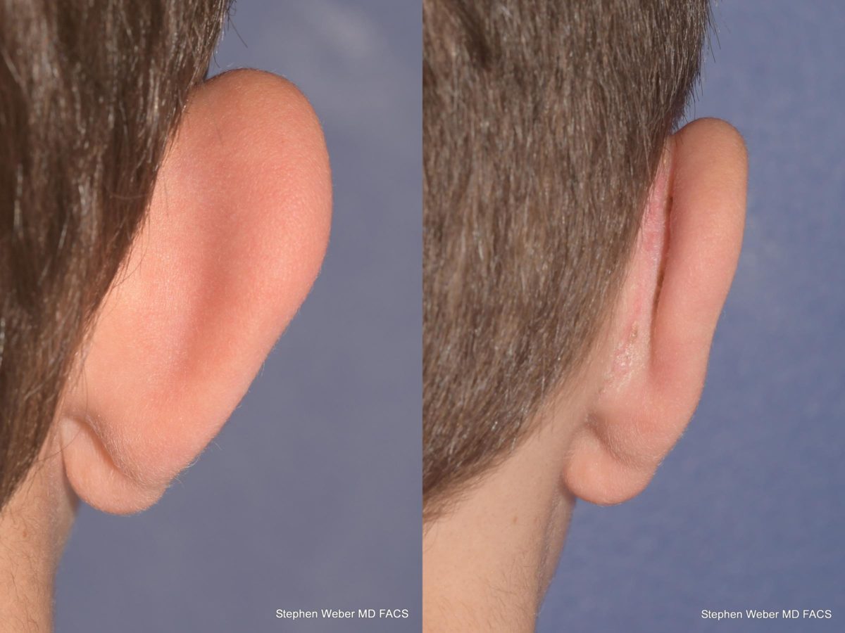 Otoplasty Before and After | Weber Facial Plastic Surgery