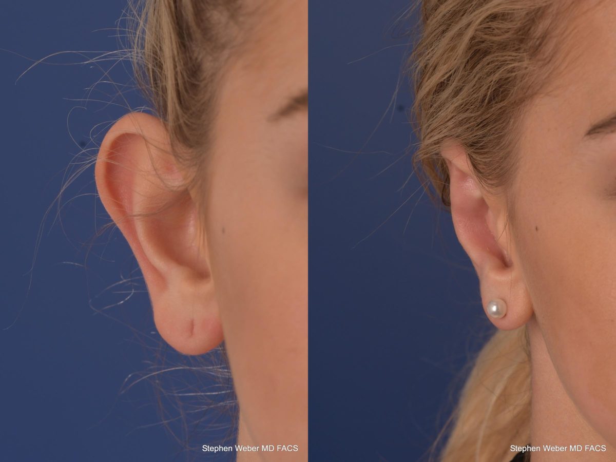 Otoplasty Before and After | Weber Facial Plastic Surgery