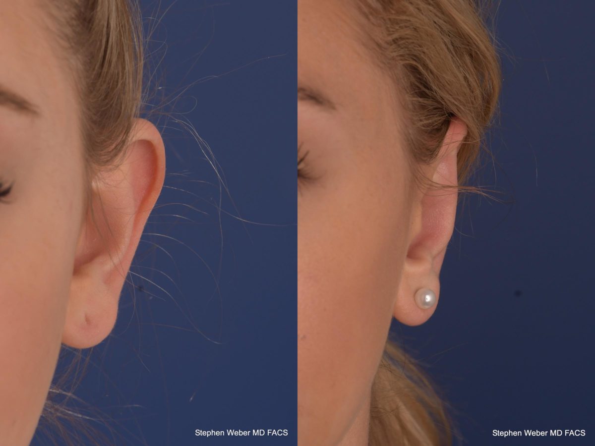 Otoplasty Before and After | Weber Facial Plastic Surgery