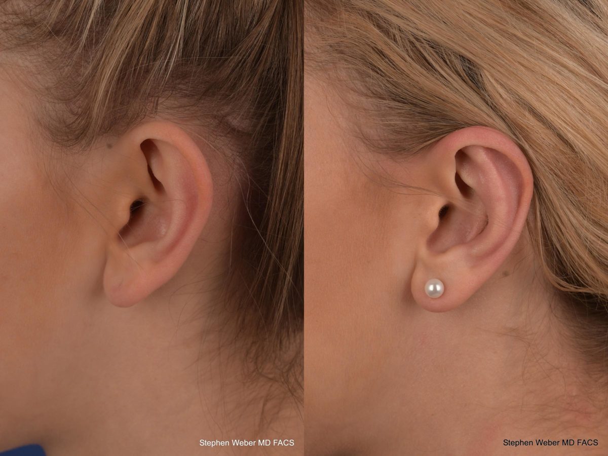 Otoplasty Before and After | Weber Facial Plastic Surgery