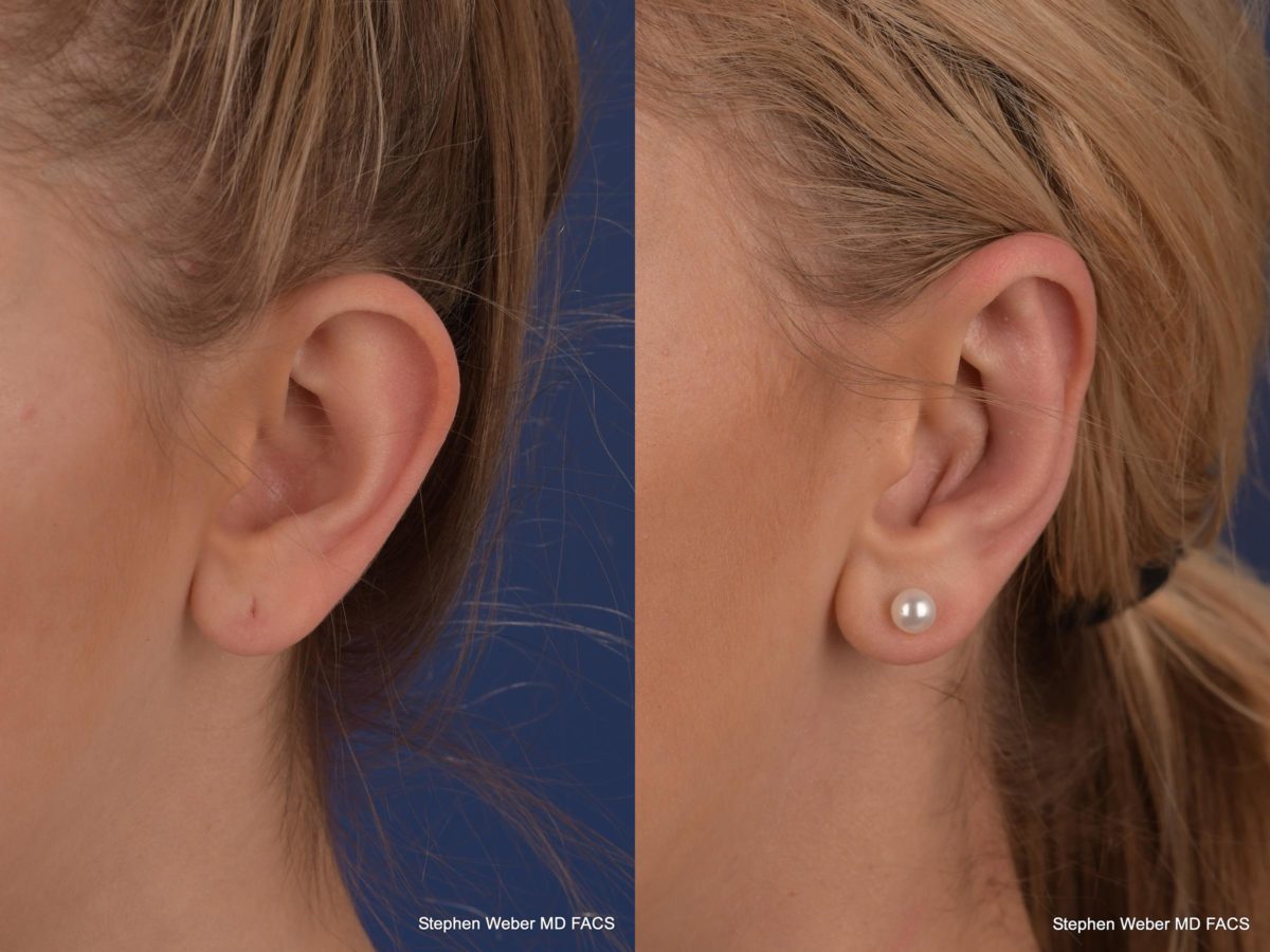 Otoplasty Before and After | Weber Facial Plastic Surgery