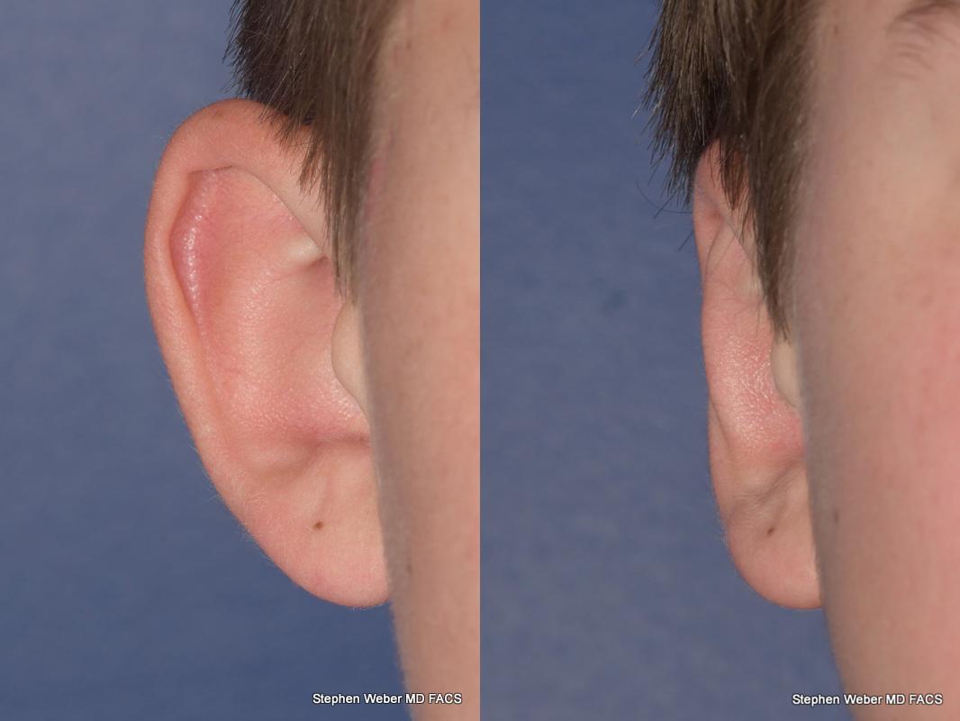 Otoplasty Before and After | Weber Facial Plastic Surgery