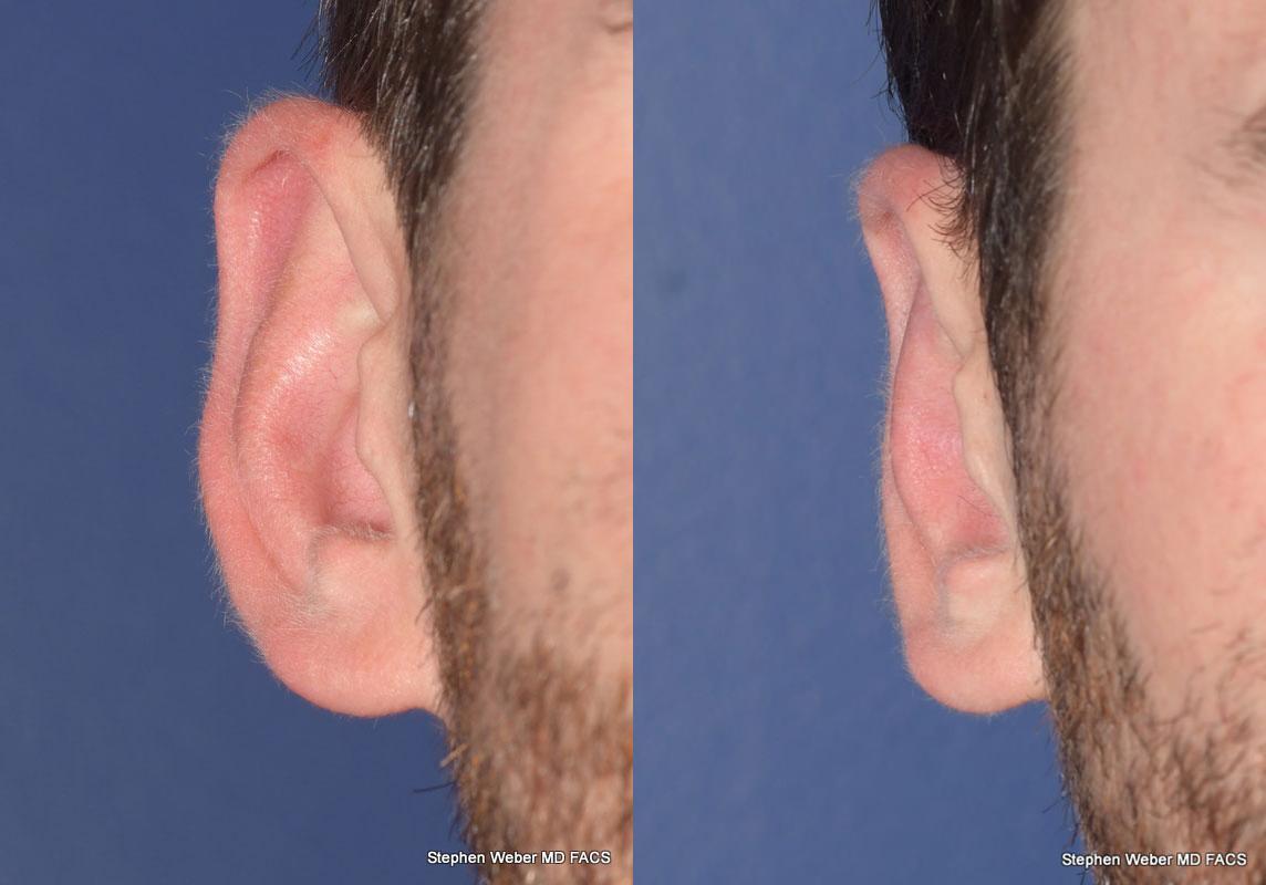 Otoplasty Before and After | Weber Facial Plastic Surgery