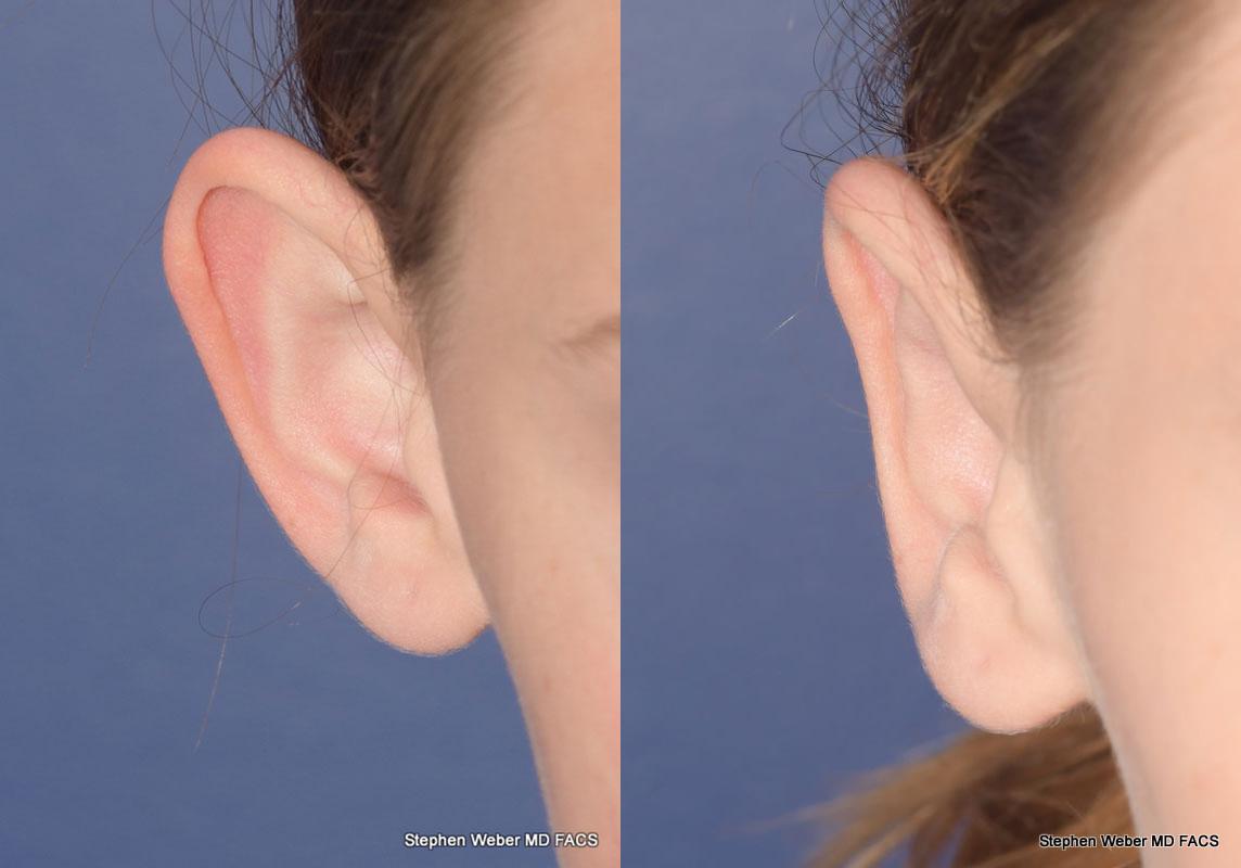 Otoplasty Before and After | Weber Facial Plastic Surgery