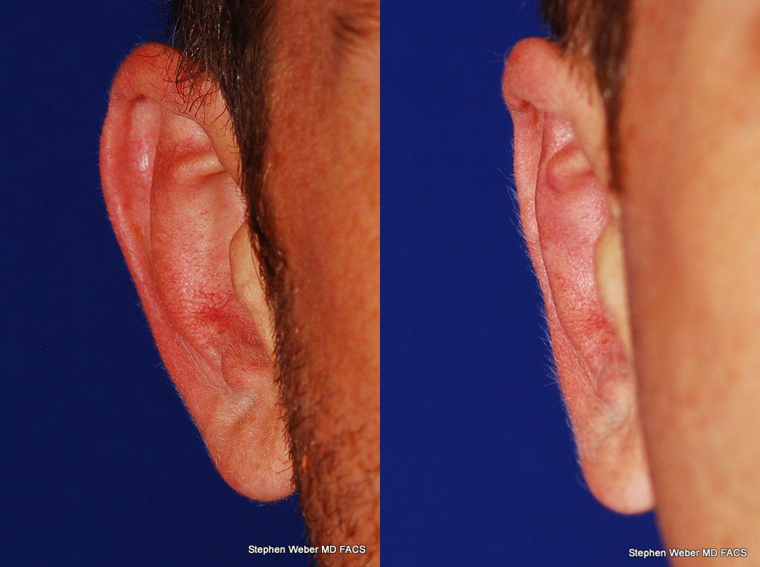 Otoplasty Before and After | Weber Facial Plastic Surgery