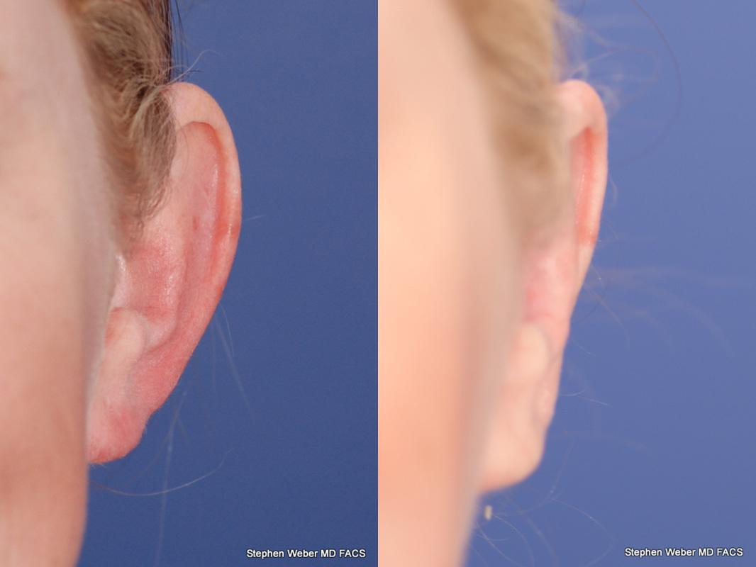 Otoplasty Before and After | Weber Facial Plastic Surgery