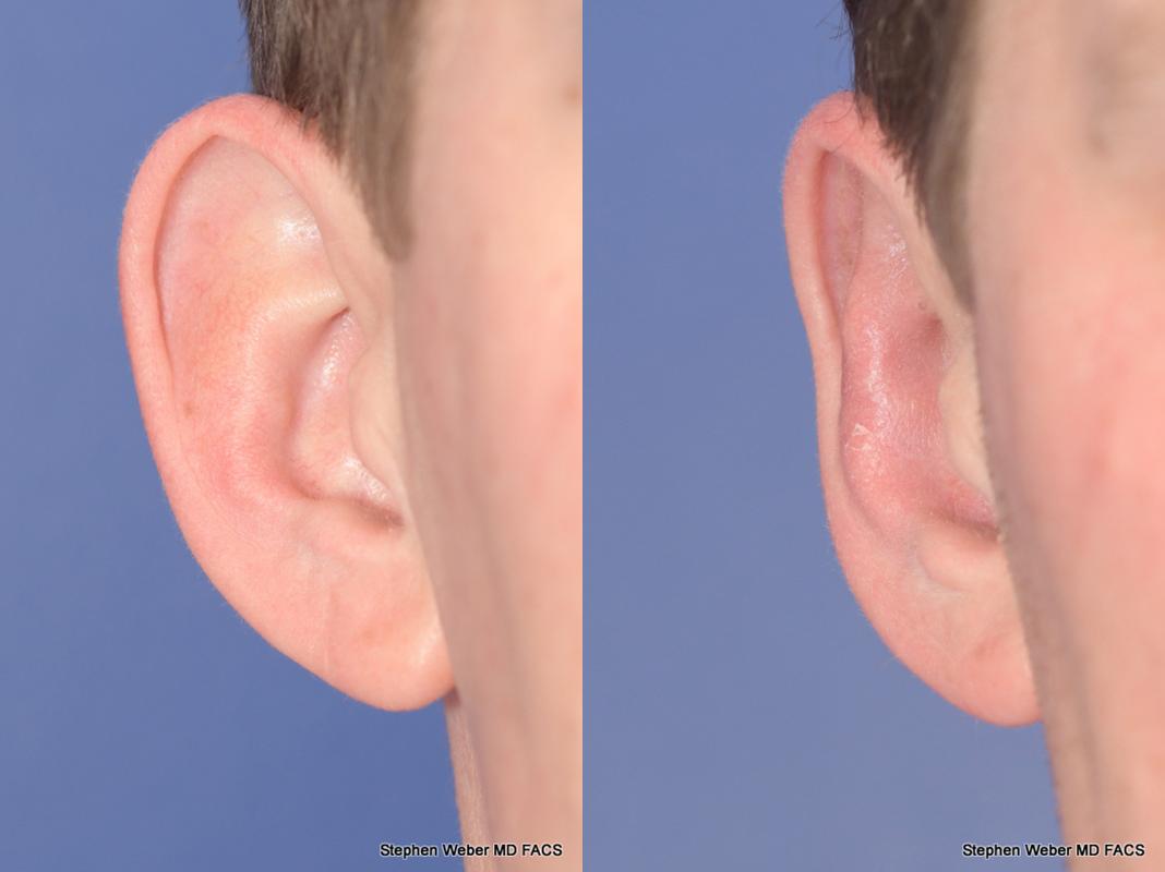 Otoplasty Before and After | Weber Facial Plastic Surgery