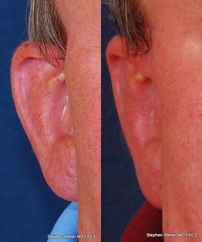 Otoplasty Before and After | Weber Facial Plastic Surgery