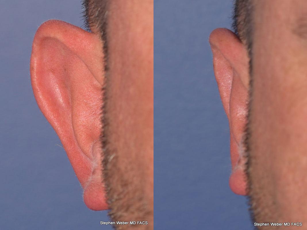 Otoplasty Before and After | Weber Facial Plastic Surgery