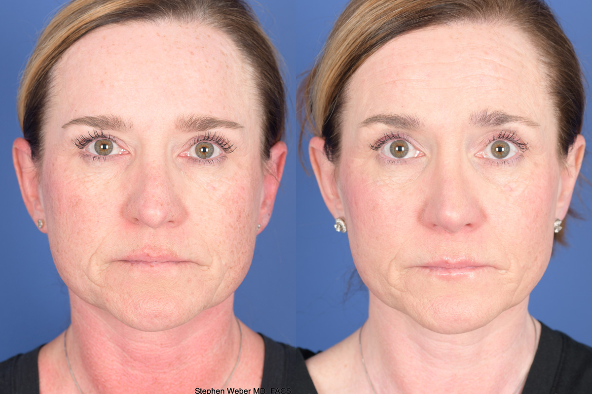 Revision Rhinoplasty Before and After | Weber Facial Plastic Surgery