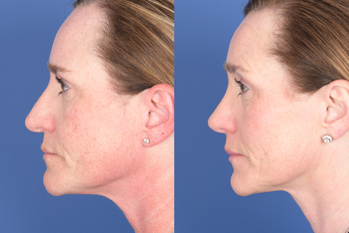 Revision Rhinoplasty Before and After | Weber Facial Plastic Surgery