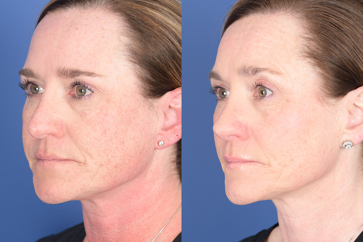 Revision Rhinoplasty Before and After | Weber Facial Plastic Surgery