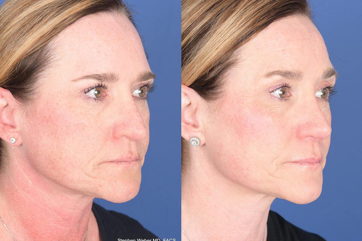 Revision Rhinoplasty Before and After | Weber Facial Plastic Surgery