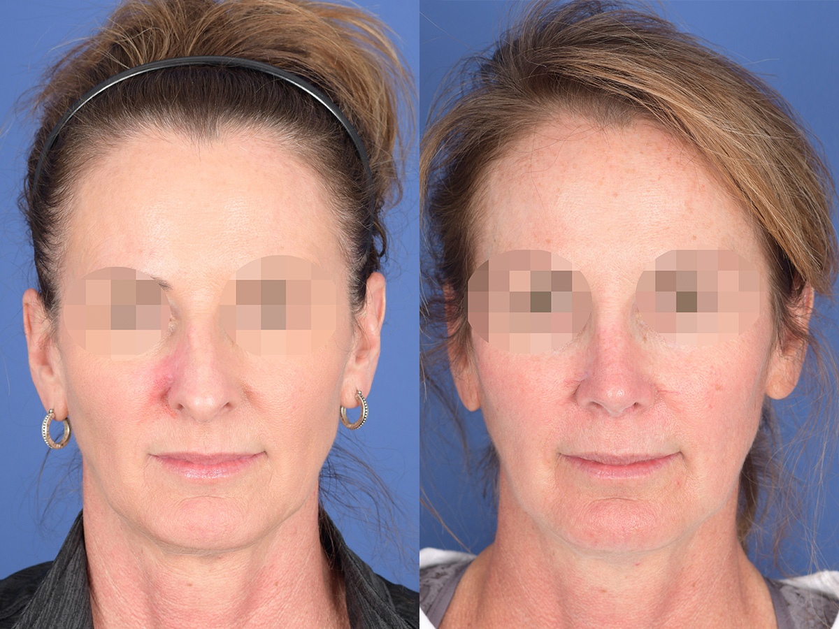 Revision Rhinoplasty Before and After | Weber Facial Plastic Surgery