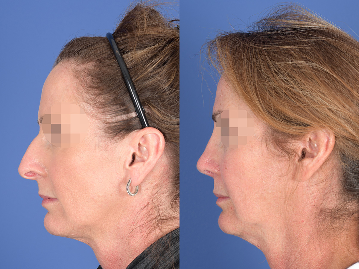 Revision Rhinoplasty Before and After | Weber Facial Plastic Surgery