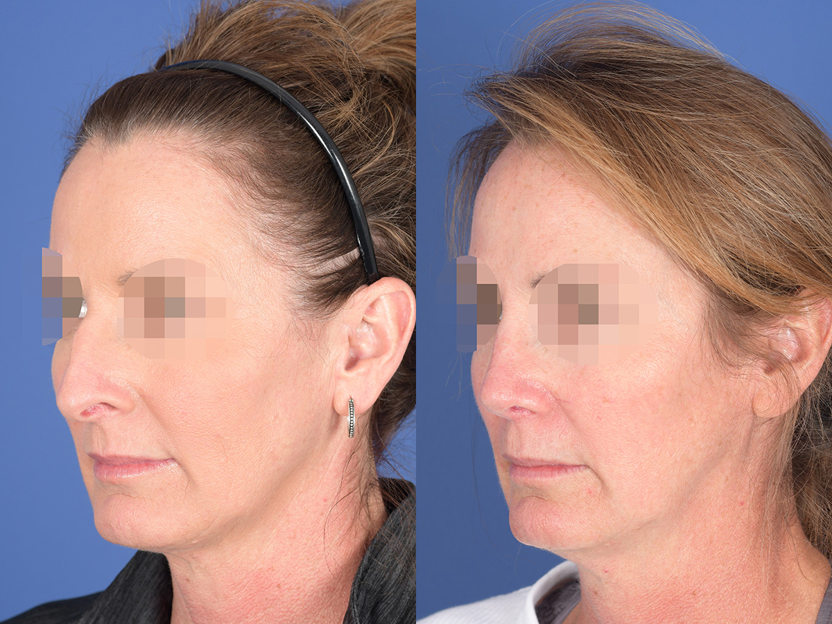 Revision Rhinoplasty Before and After | Weber Facial Plastic Surgery