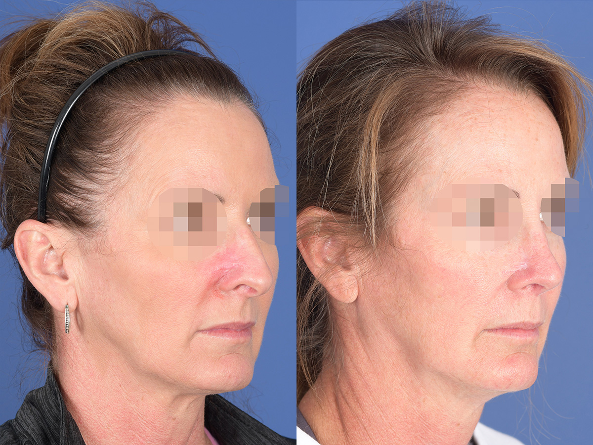 Revision Rhinoplasty Before and After | Weber Facial Plastic Surgery