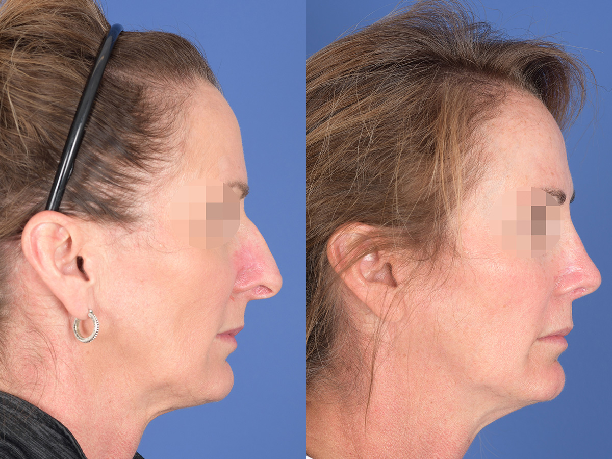 Revision Rhinoplasty Before and After | Weber Facial Plastic Surgery