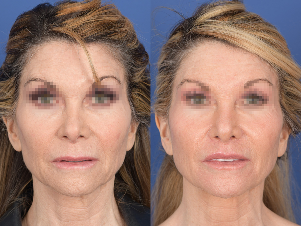 Revision Rhinoplasty Before and After | Weber Facial Plastic Surgery