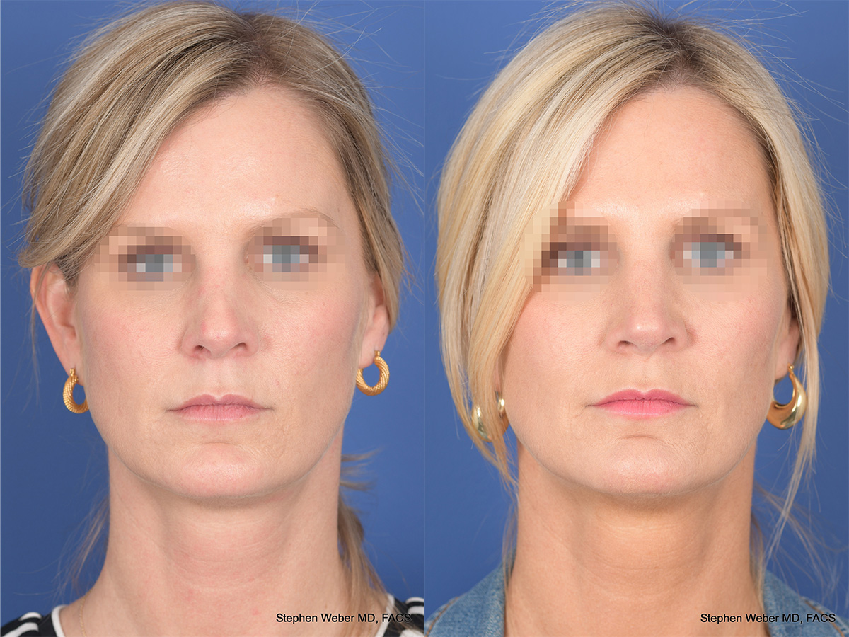 Revision Rhinoplasty Before and After | Weber Facial Plastic Surgery