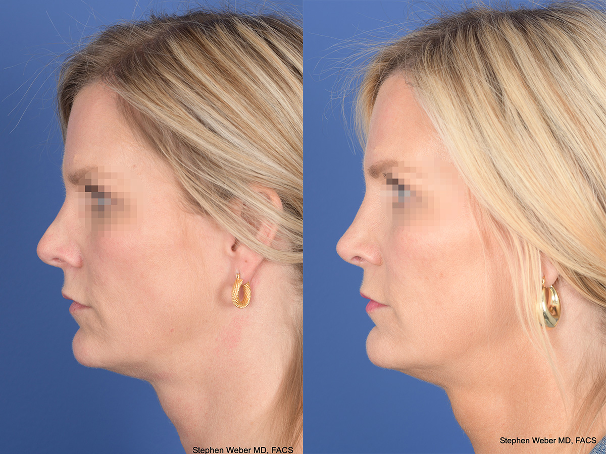Revision Rhinoplasty Before and After | Weber Facial Plastic Surgery