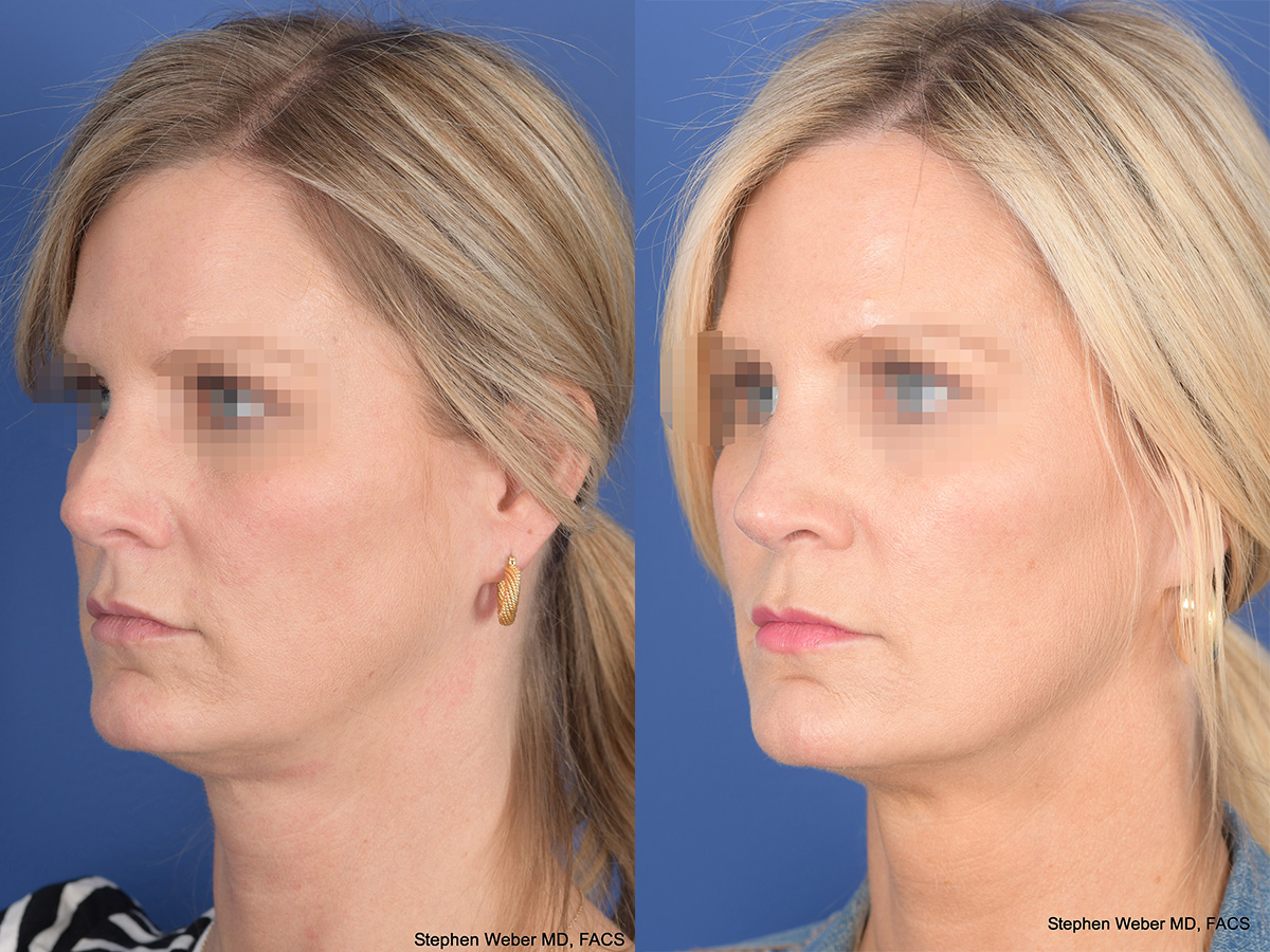 Revision Rhinoplasty Before and After | Weber Facial Plastic Surgery