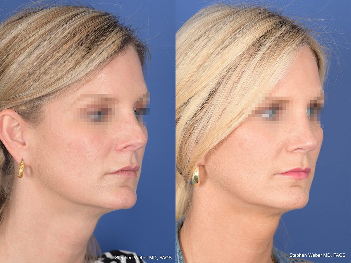 Revision Rhinoplasty Before and After | Weber Facial Plastic Surgery