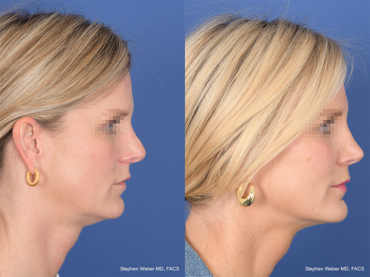 Revision Rhinoplasty Before and After | Weber Facial Plastic Surgery