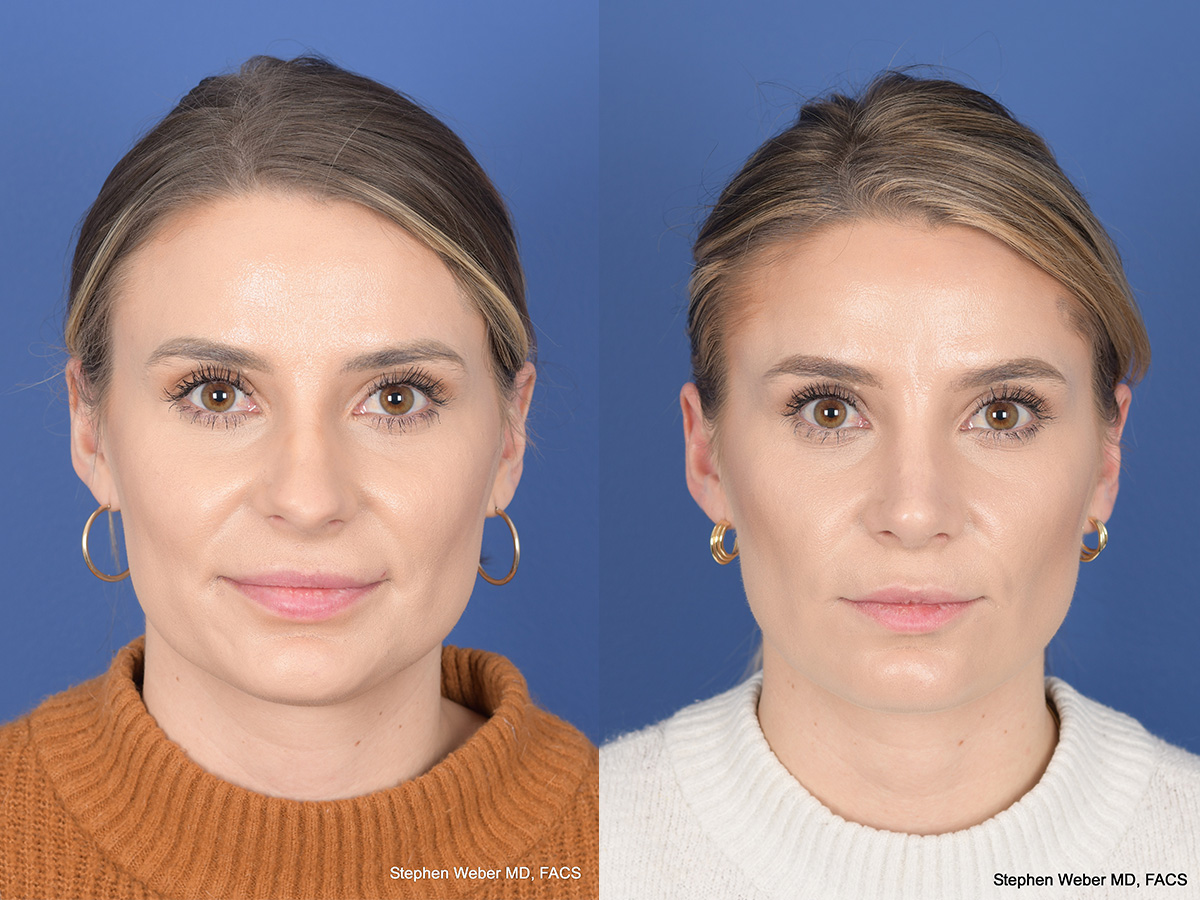 Revision Rhinoplasty Before and After | Weber Facial Plastic Surgery