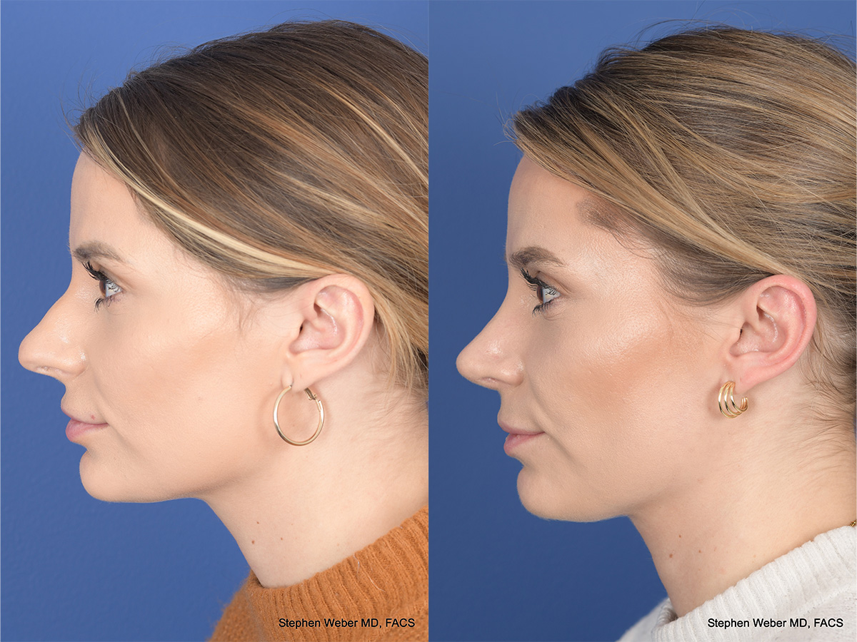 Revision Rhinoplasty Before and After | Weber Facial Plastic Surgery