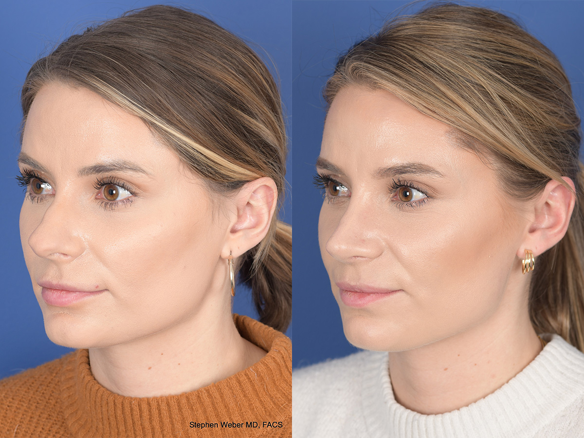 Revision Rhinoplasty Before and After | Weber Facial Plastic Surgery