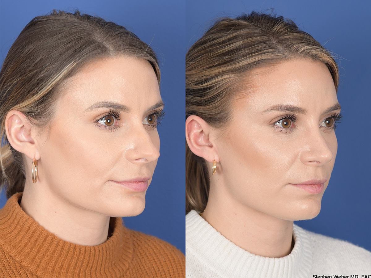 Revision Rhinoplasty Before and After | Weber Facial Plastic Surgery