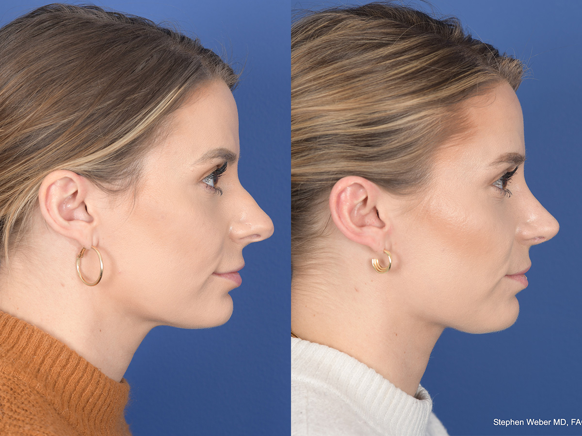 Revision Rhinoplasty Before and After | Weber Facial Plastic Surgery