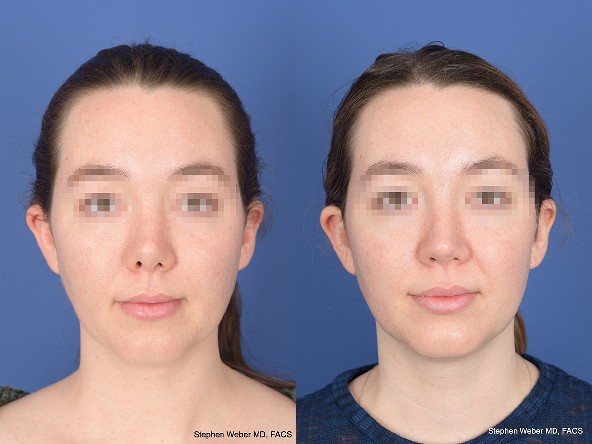 Revision Rhinoplasty Before and After | Weber Facial Plastic Surgery