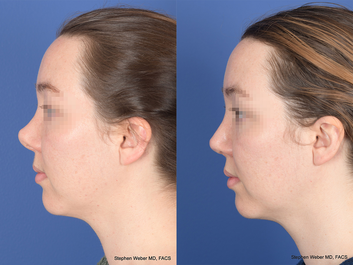 Revision Rhinoplasty Before and After | Weber Facial Plastic Surgery