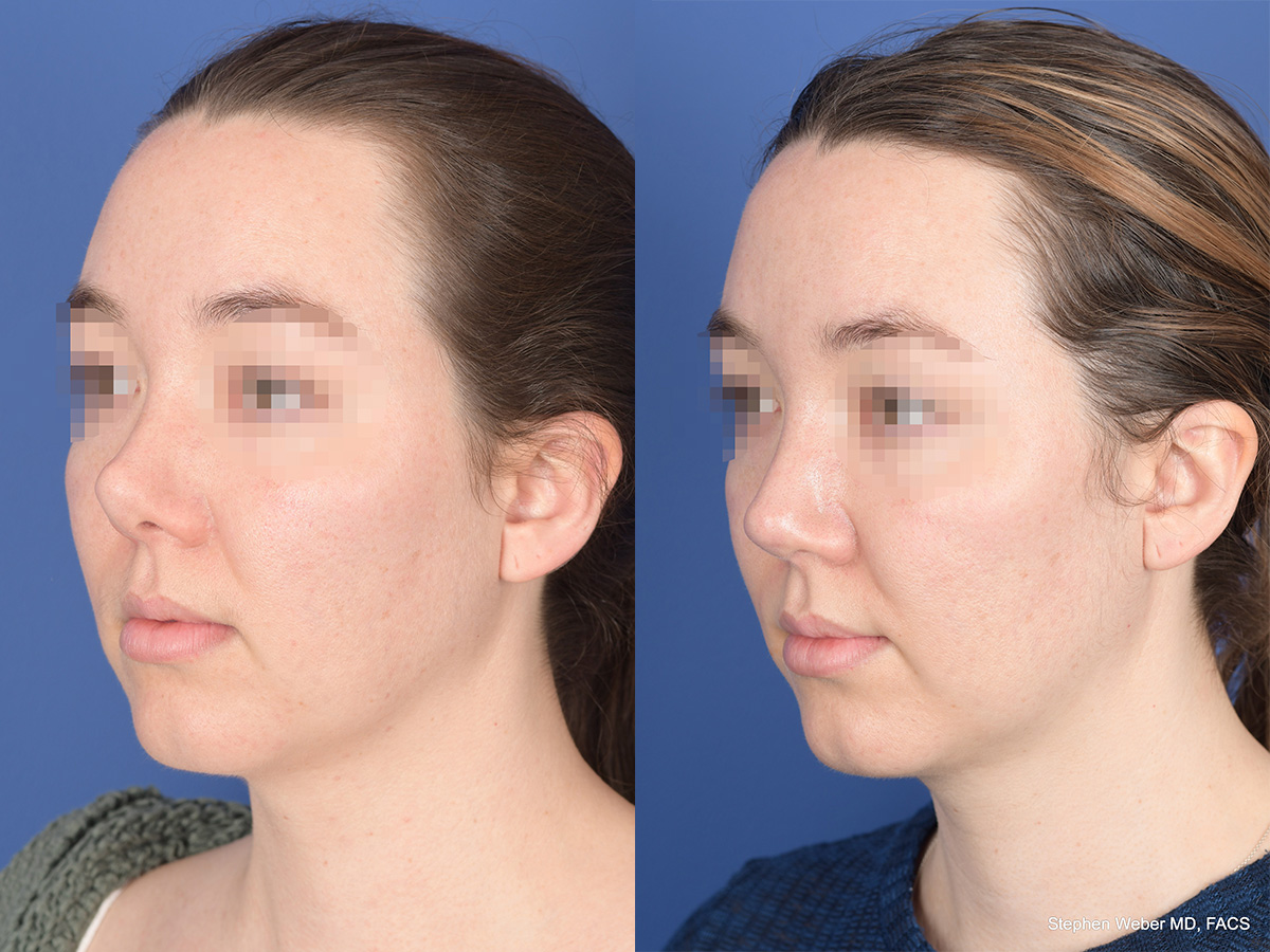 Revision Rhinoplasty Before and After | Weber Facial Plastic Surgery