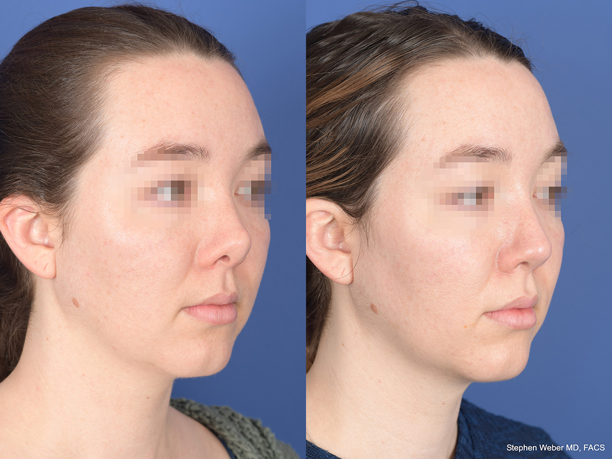 Revision Rhinoplasty Before and After | Weber Facial Plastic Surgery