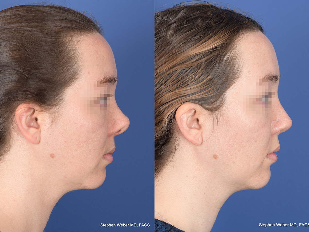 Revision Rhinoplasty Before and After | Weber Facial Plastic Surgery