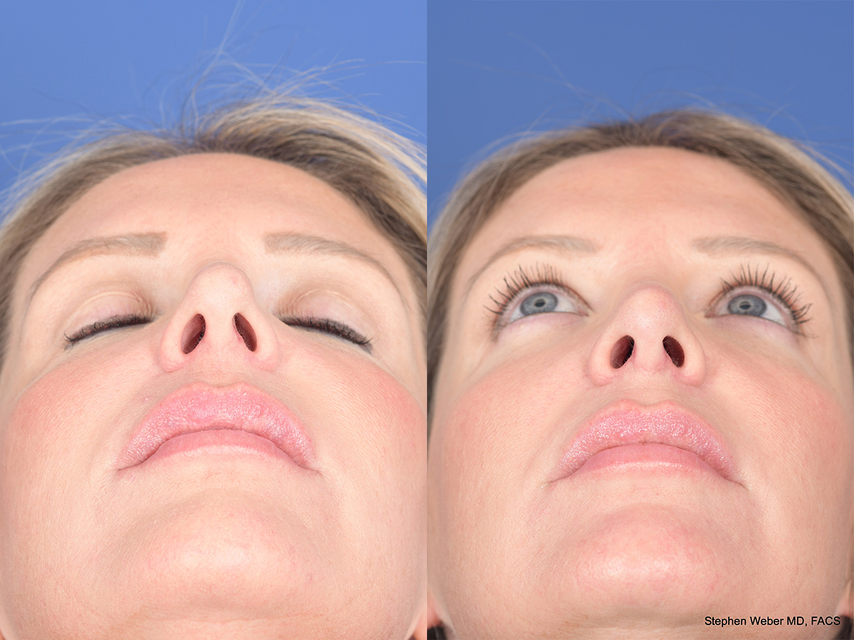 Revision Rhinoplasty Before and After | Weber Facial Plastic Surgery