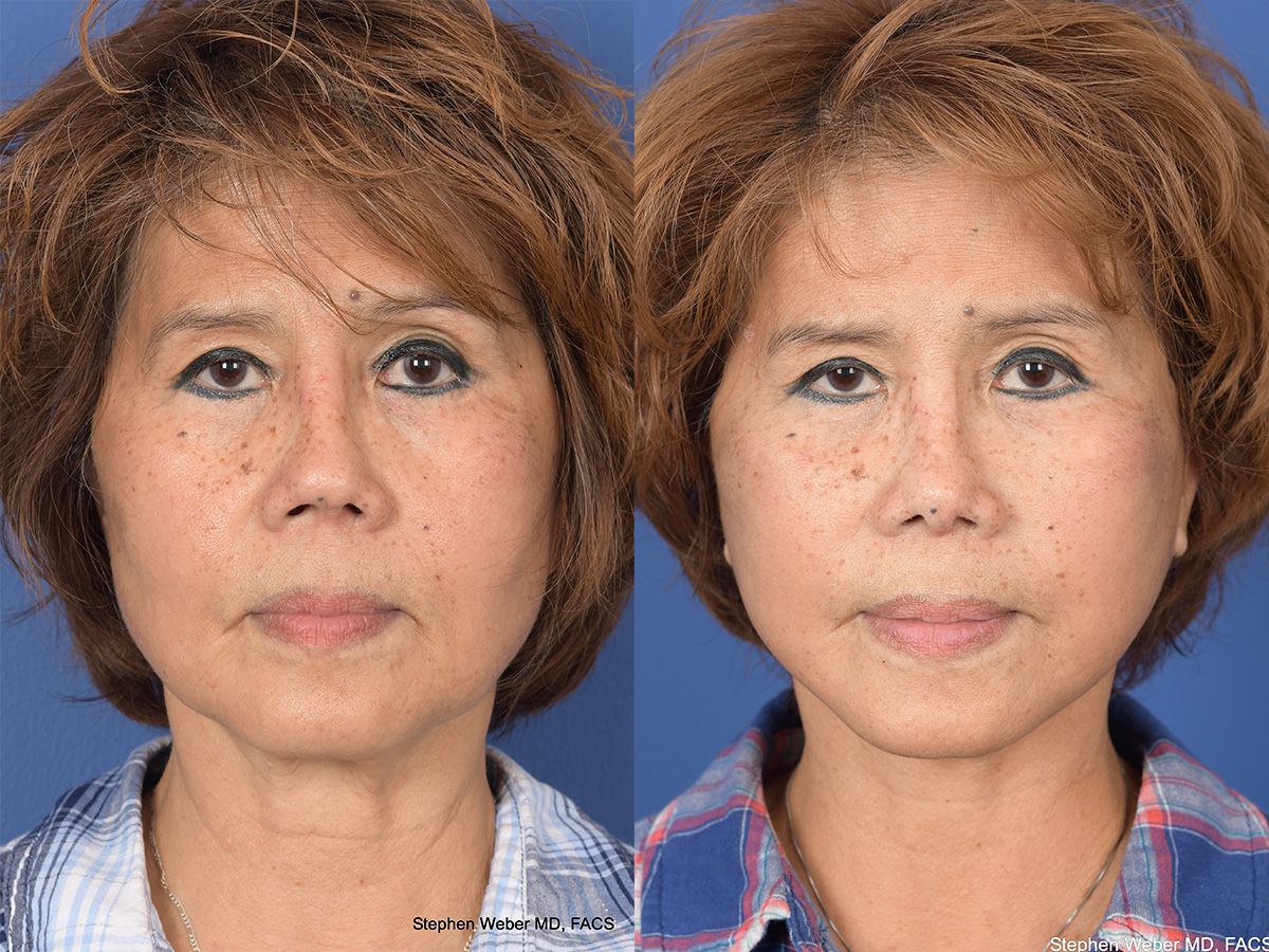 Revision Rhinoplasty Before and After | Weber Facial Plastic Surgery