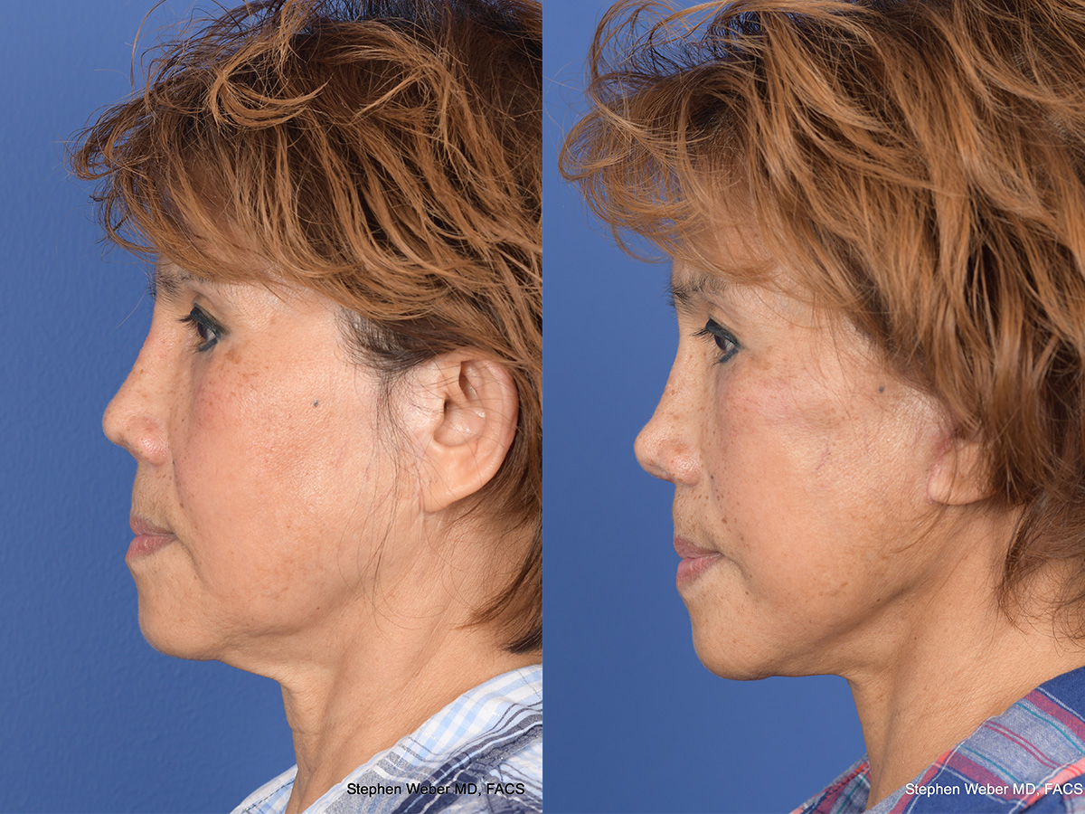 Revision Rhinoplasty Before and After | Weber Facial Plastic Surgery