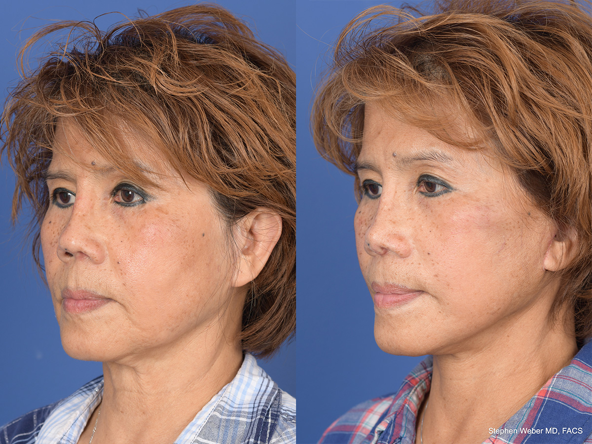 Revision Rhinoplasty Before and After | Weber Facial Plastic Surgery