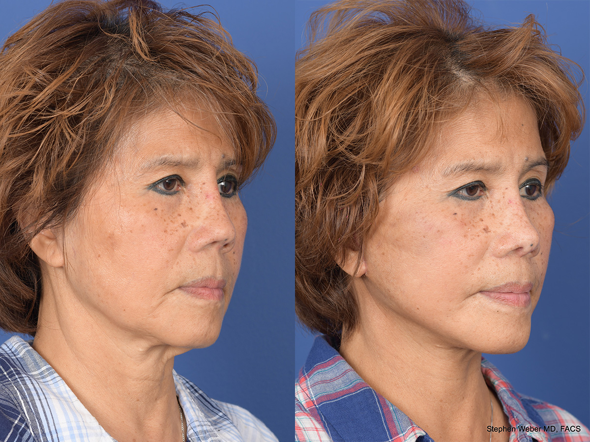 Revision Rhinoplasty Before and After | Weber Facial Plastic Surgery