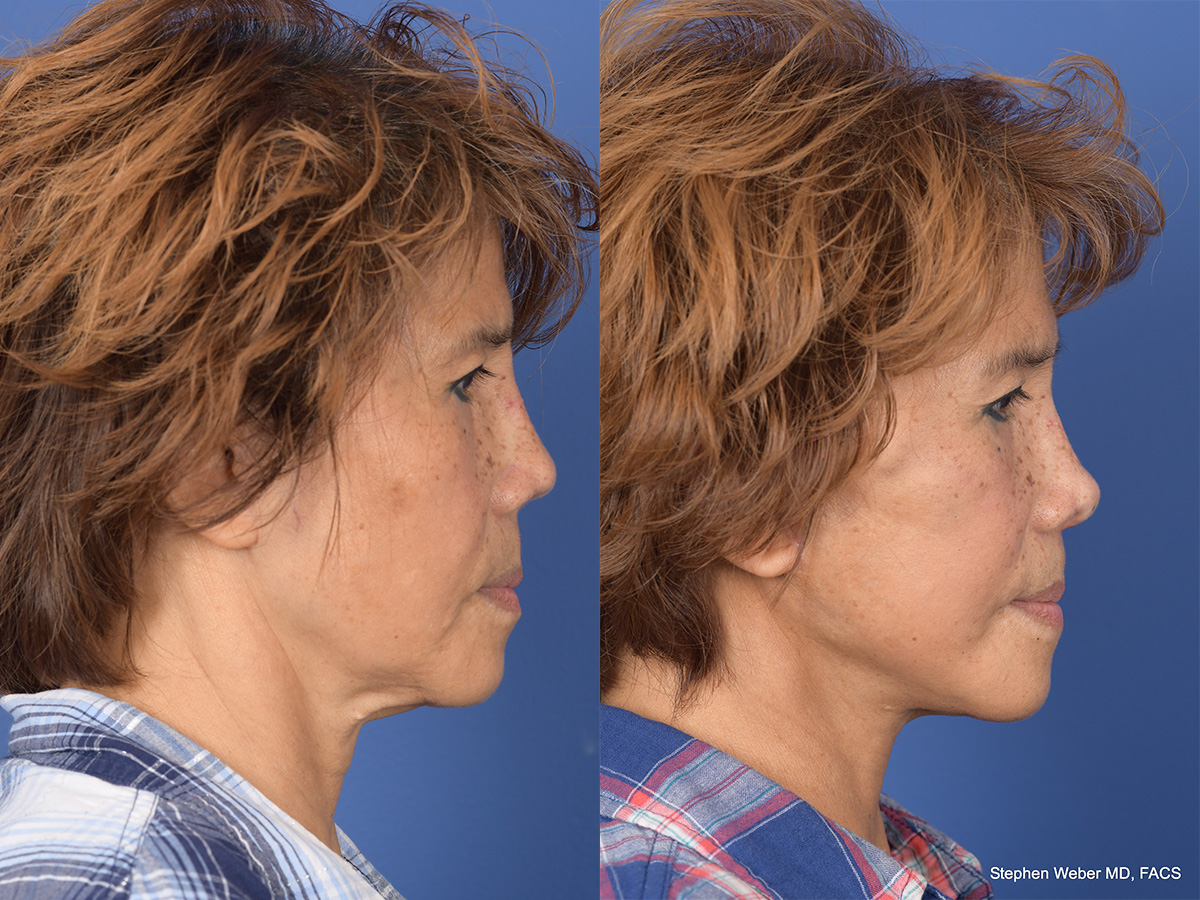 Revision Rhinoplasty Before and After | Weber Facial Plastic Surgery
