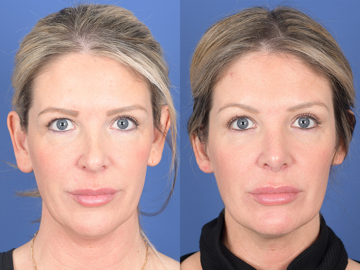 Revision Rhinoplasty Before and After | Weber Facial Plastic Surgery